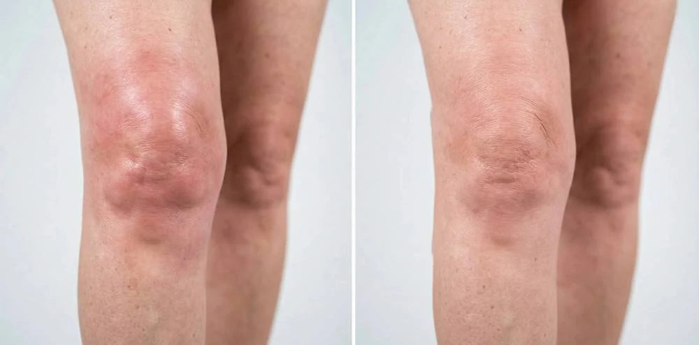 Supplied side-by-side knee-area appearance reference; not a verified product result